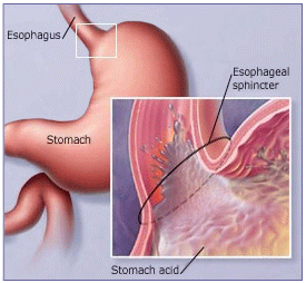 Acid-Reflux.gif